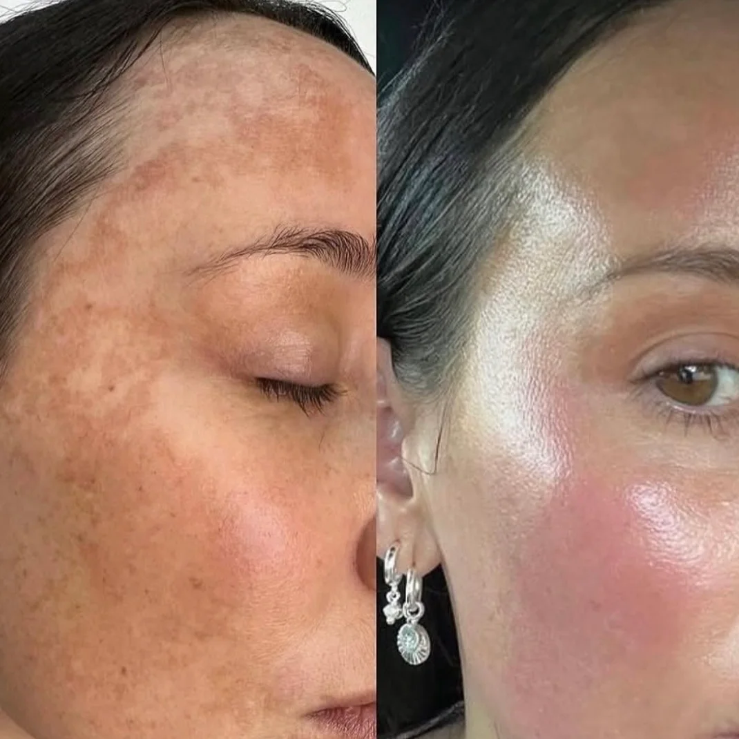 Before and after a course of chemical peels, with pigmentation across the forehead and cheek noticeably lighter.